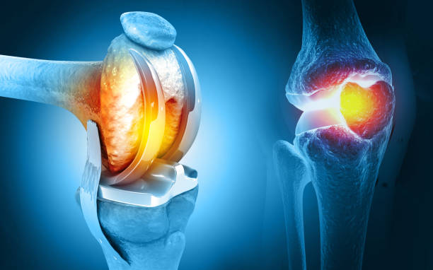 A importância de fazer a cirurgia de prótese de joelho com rapidez