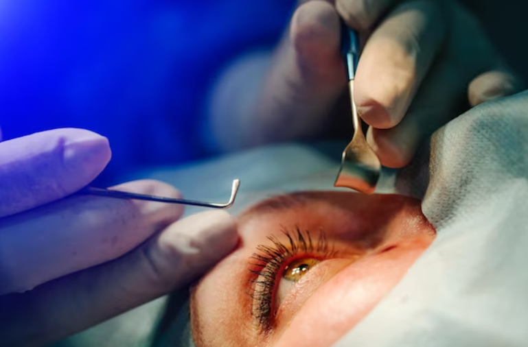 Mitos e verdades sobre a cirurgia de catarata