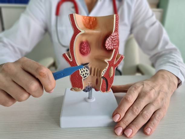A importância de fazer a cirurgia de hemorroida com rapidez
