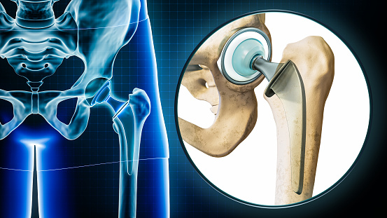 A importância de fazer a cirurgia de prótese de quadril com rapidez